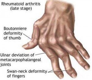 Rheumatoid