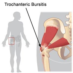 Lateral Hip Pain/ Trochanteric Bursitis