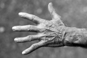 arthritis in hands