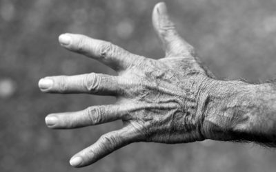 Treatment for Arthritis in Hands