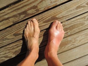 Osteoarthritis of the Big Toe