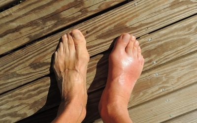 Osteoarthritis of the Big Toe