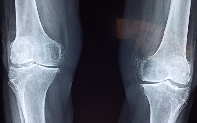 Osteoarthritis: Complications and Outlooks