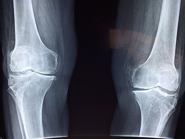 Osteoarthritis: Complications and Outlooks