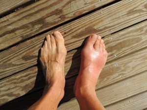 Gout Symptoms And Treatments