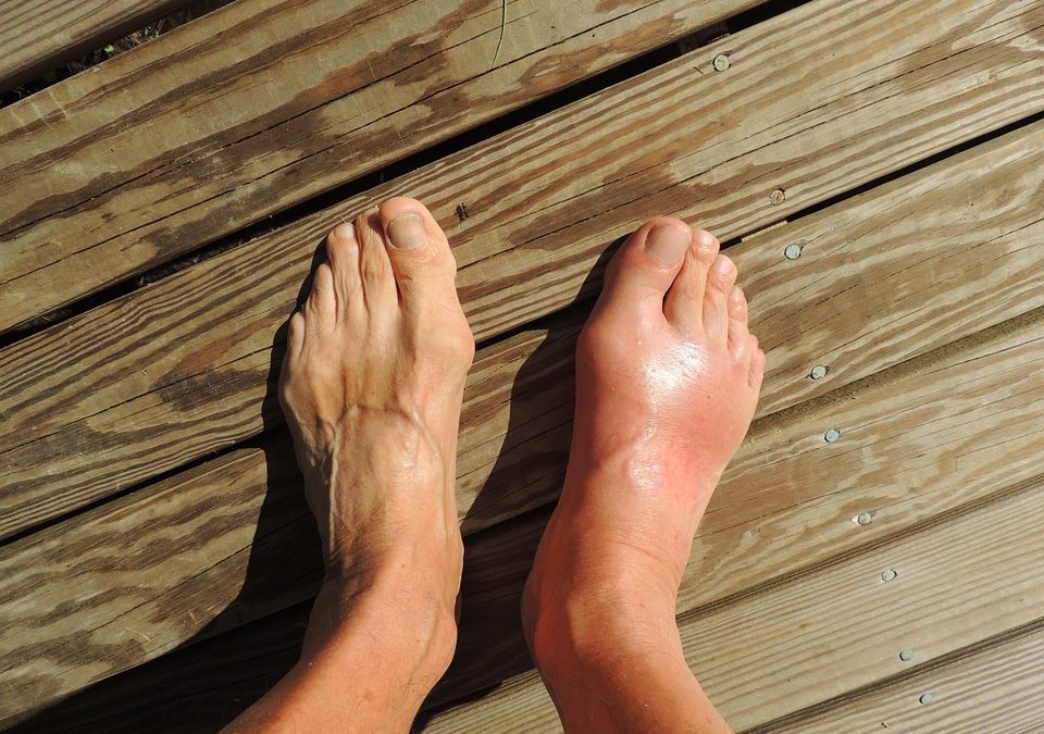 Gout  – Treating, Relieving and Preventing the Problem of Gout