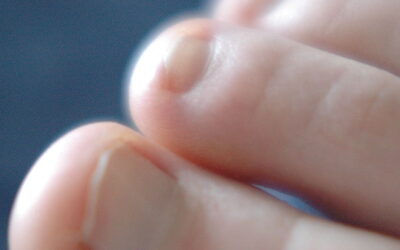 Common Symptoms of Toe Joint Pain